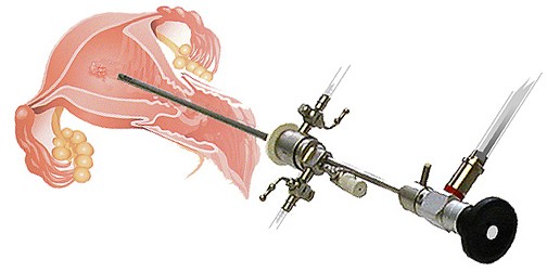 Гистероскопия и ЭКО. Почему не надо бояться