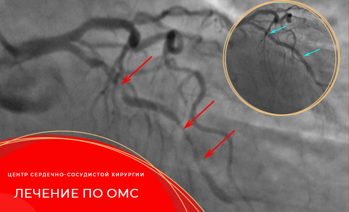 Лечение заболеваний сердца и сосудов по полису ОМС